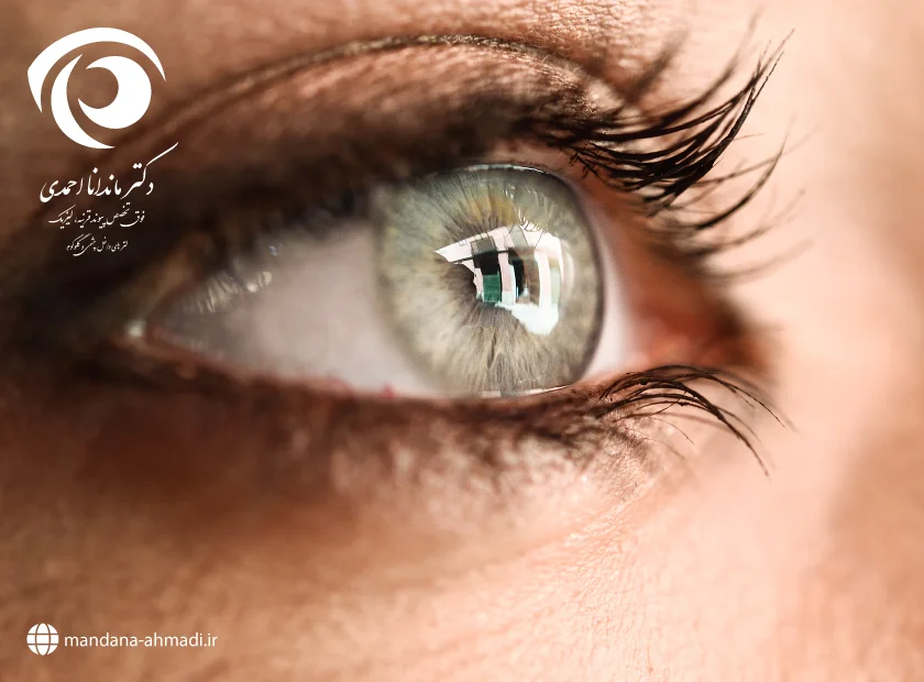 عمل چشم لیزیک چگونه انجام می‌شود؟