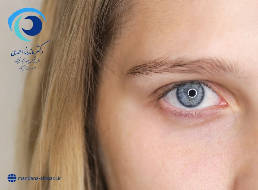 عوارض عمل لیزیک چشم