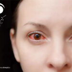 قرمزی چشم یا Red Eye
