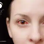 قرمزی چشم یا Red Eye