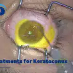 اصلاح قوز قرنیه، بازگرداندن وضوح به دنیای شما