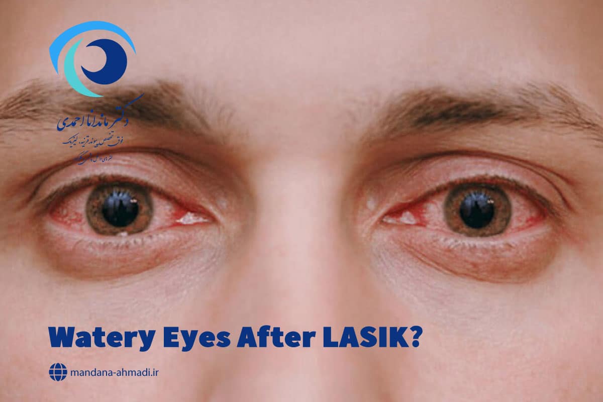 علت آبریزش چشم بعد از عمل لیزیک