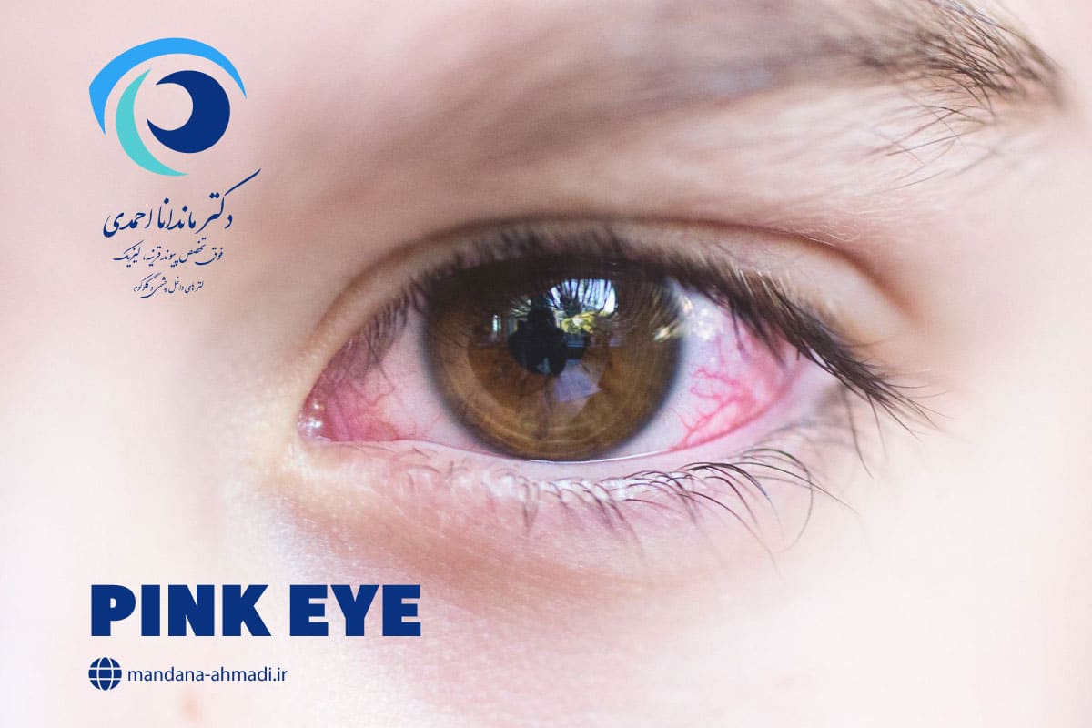 ورم ملتحمه چشم