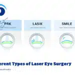 تفاوت لیزیک (فمتولیزیک)، لازک (پی آرکی، ترانس پی آرکی)، اسمایل چیست؟