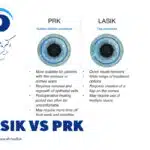 لیزیک یا پی آرکی؟