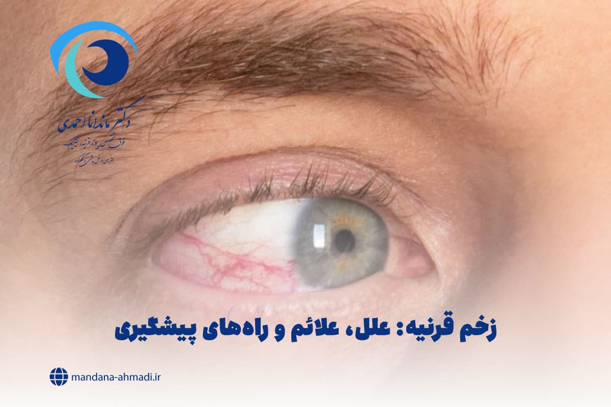زخم قرنیه