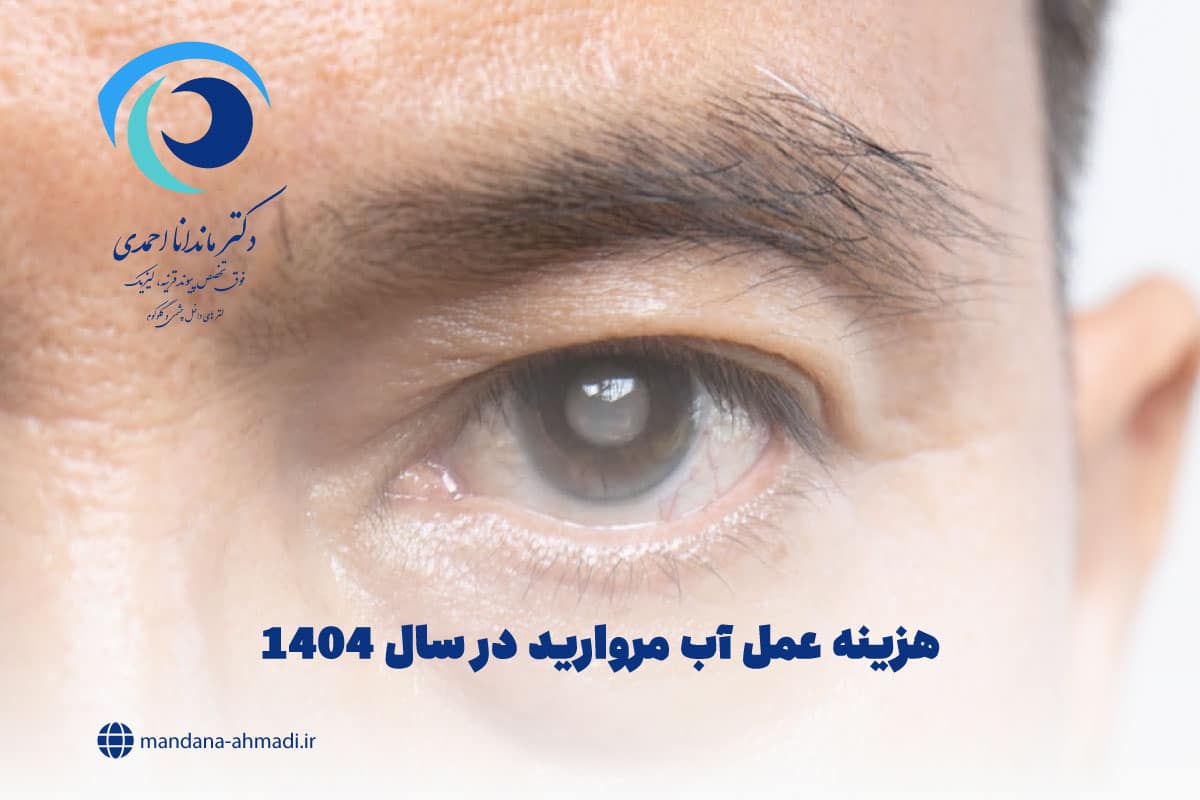 هزینه عمل آب مروارید