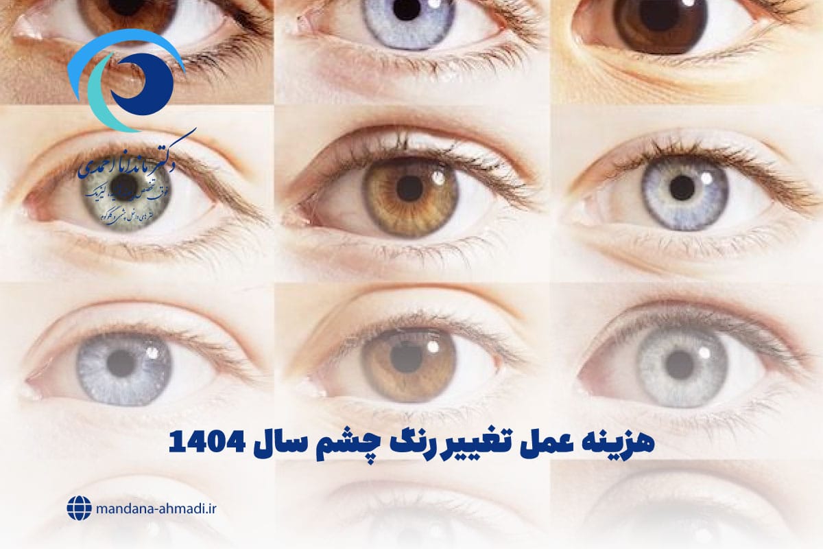 هزینه عمل تغییر رنگ چشم