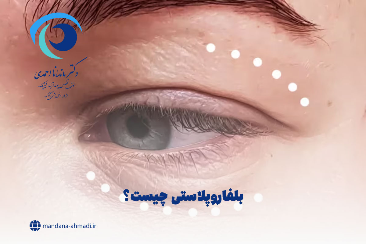 بلفاروپلاستی چیست