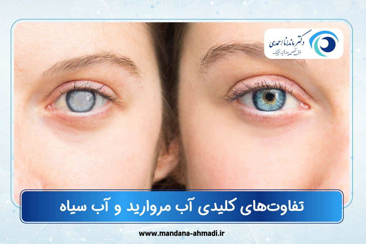 تفاوت آب مروارید و آب سیاه