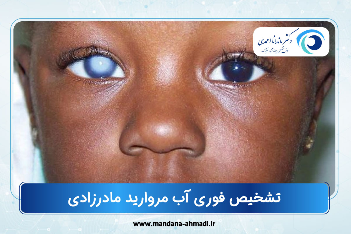 آب مروارید مادرزادی