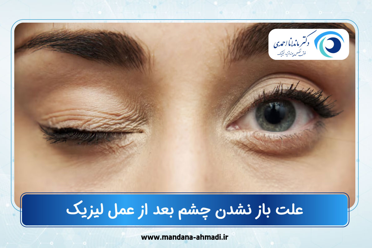 علت باز نشدن چشم بعد از عمل لیزیک