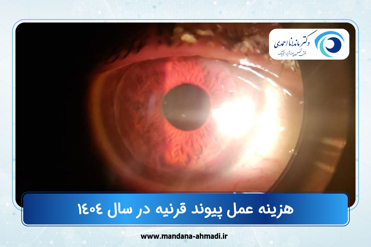 هزینه عمل پیوند قرنیه در سال ۱۴۰۴